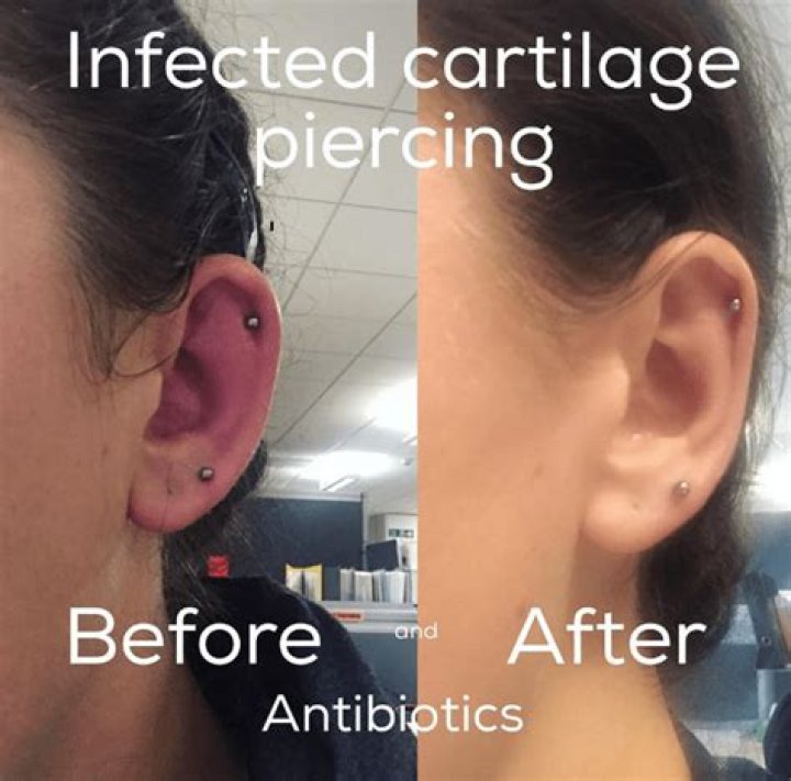 Can a cartilage piercing make you sick?
