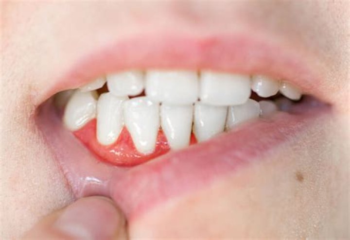 Can Gingivitis Cause white gums?