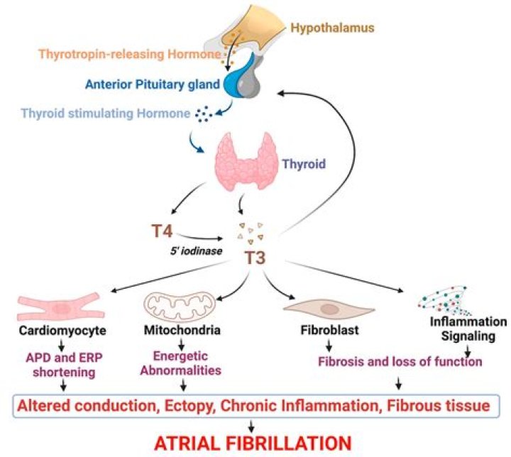 Can hypothyroidism cause heart block?