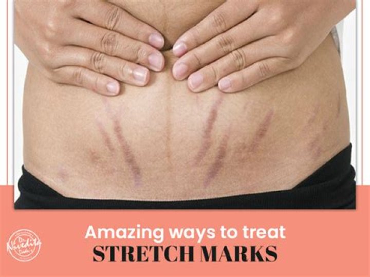 Can I get my stretch marks removed?