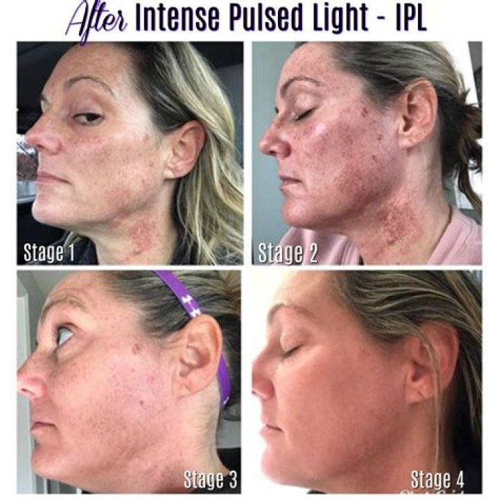 Does IPL have any side effects?