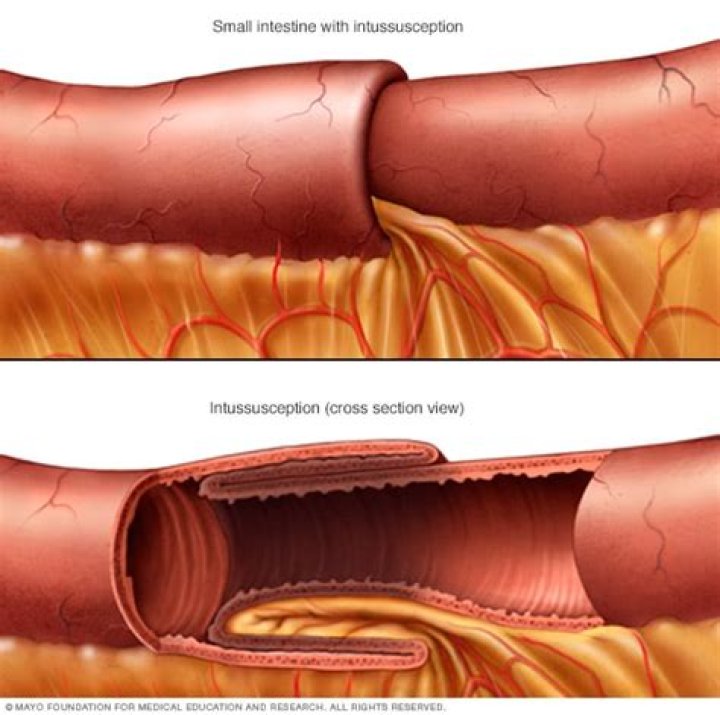 How do you fix rectal descent?