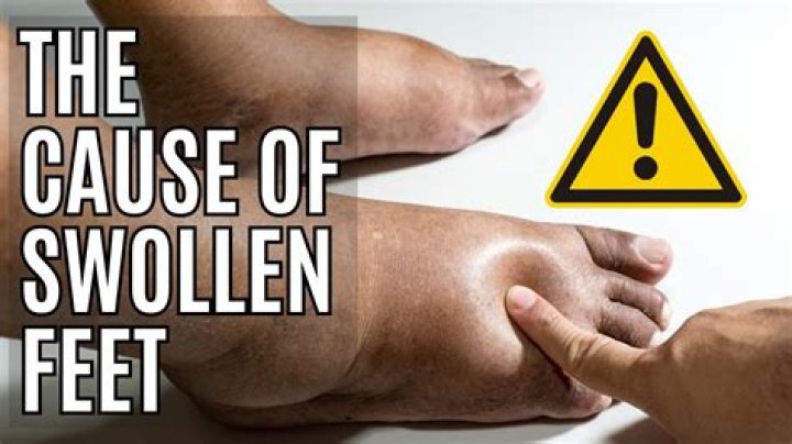 How high should I elevate my swollen feet?
