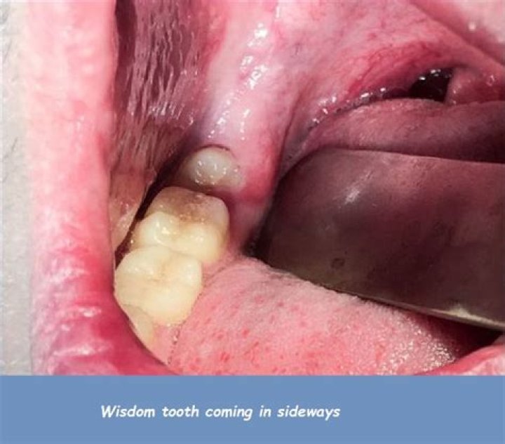 How long does a wisdom tooth take to come in?