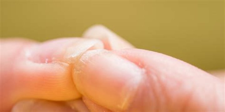 What causes weak nails and hair?