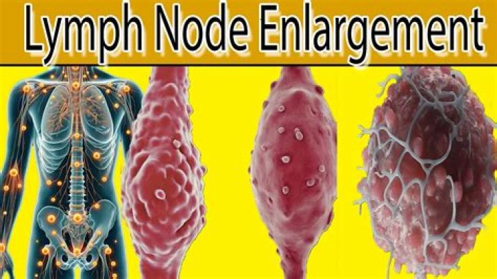 What does an enlarged lymph node on your mammogram mean?