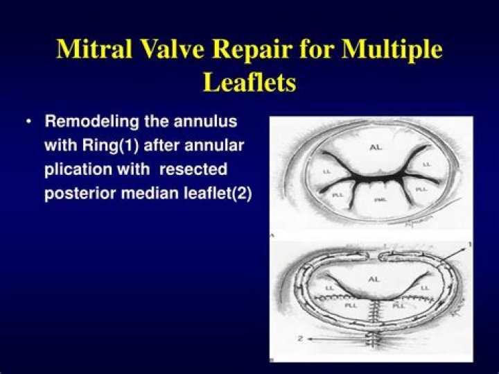 What is cleft mitral valve?