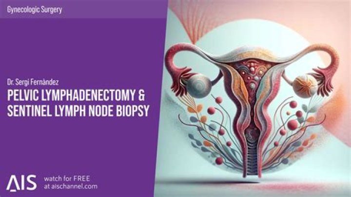 What is pelvic lymphadenectomy?