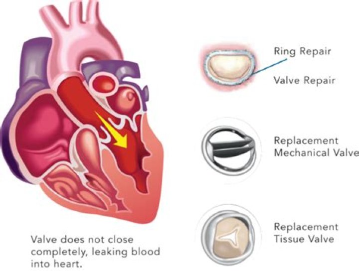 What is the correct code for a leaking heart valve prosthesis initial encounter?