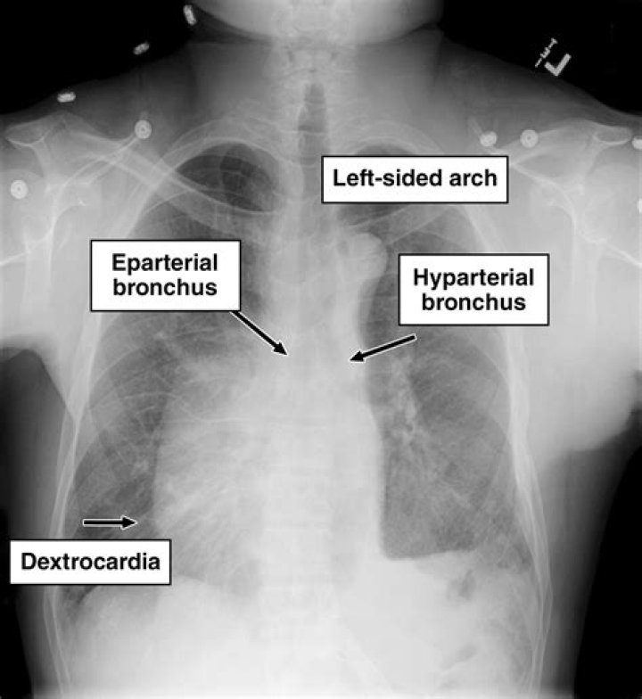 What is visceral situs?
