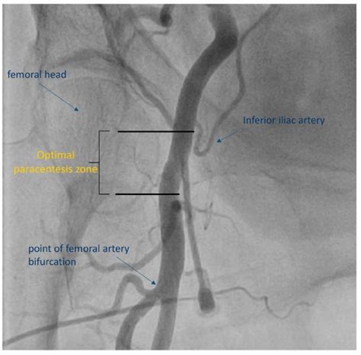 When was Angiography first used?