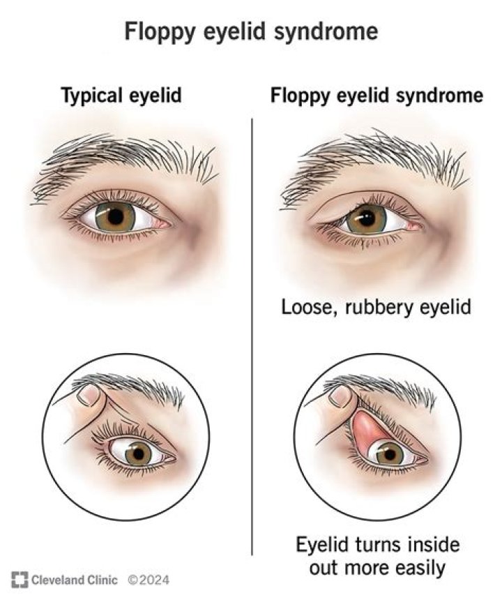 Why do my eyelids fold over twice?